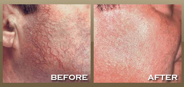 Before And After Vein Treatment. Laser Vein Removal FAQs