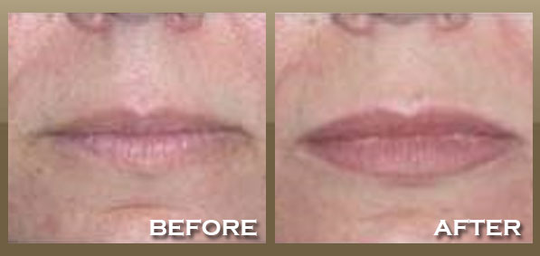 restylane lip injections before and. Restylane® Before amp; After