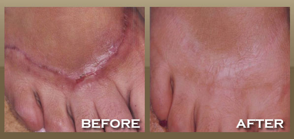 Foot Scar