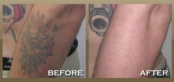 Laser Tattoo Removal - Skinpeccable
