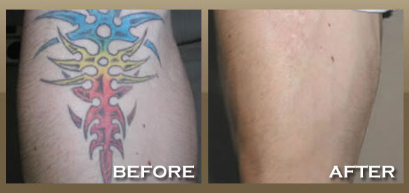 Before And After Tattoos. efore and after. Tattoo