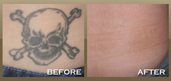 Achieve a clearer skin with laser tattoo removal Albuquerque methods