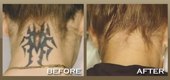 tattoo removal before after. Tattoo Removal Before amp; After