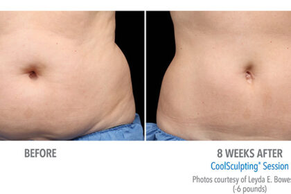 Coolsculpting Treatment