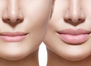 Dermal fillers For Wrinkles