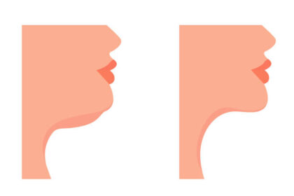 Kybella for Double Chin Reduction