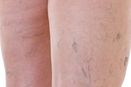 Varicose veins
