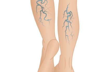 Varicose Veins