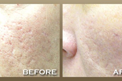 acne scars