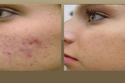acne scar treatment los angeles