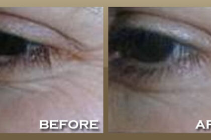 Botox injection to smooth crow’s feet