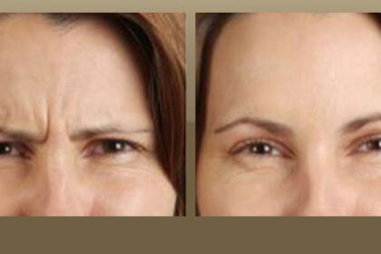 botox west hollywood