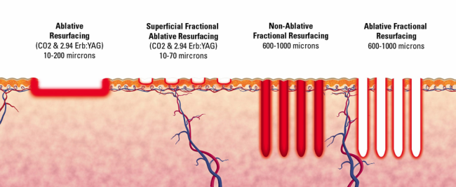 Different Fractional Technologies