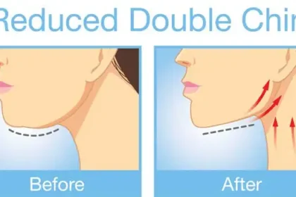 Kybella