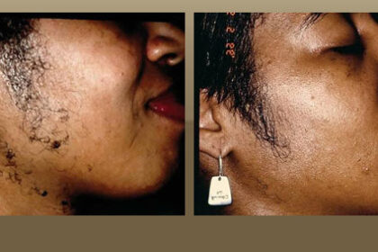 Laser hair removal Los Angeles