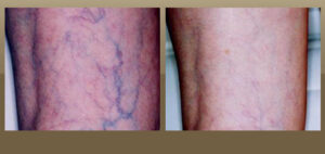 vein treatment