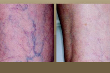 vein treatment