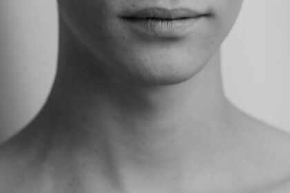 Acne and Rosacea