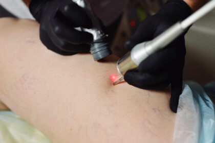 Vascular Laser Treatment