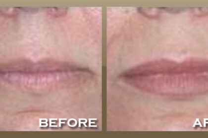 Restylane Silk
