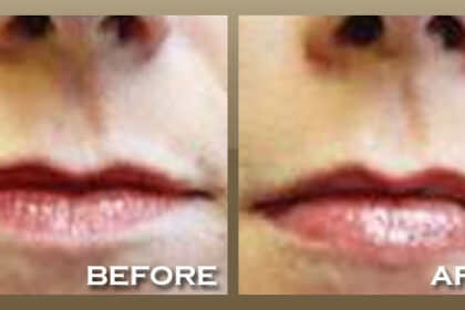 Restylane smile line filler results