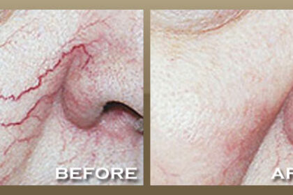 vein treatment Los Angeles