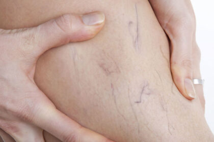 Spider Veins