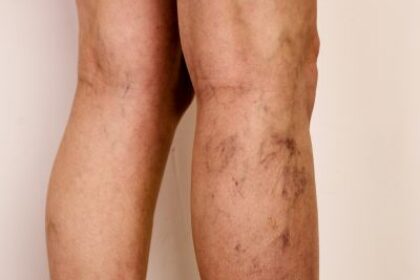 Vein Treatment