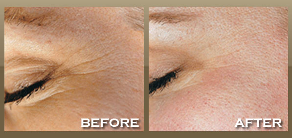 differin under eye wrinkles