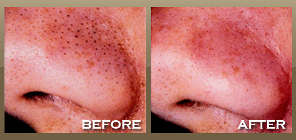 Skinpeccable | Microdermabrasion | Los Angeles