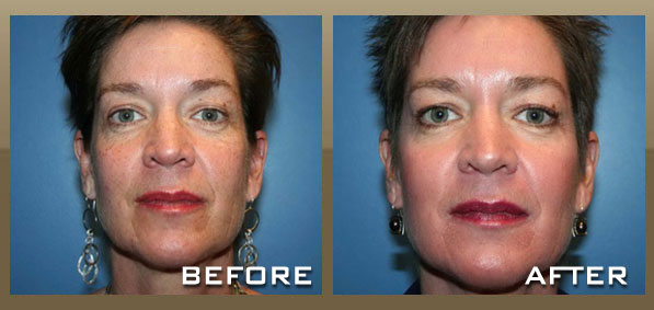 Skinpeccable | Melasma | Los Angeles