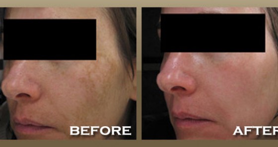 Skinpeccable | Melasma | Los Angeles
